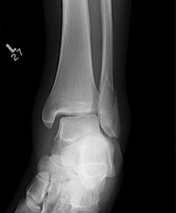 Ankle Weber B Deltoid Ligament Injury